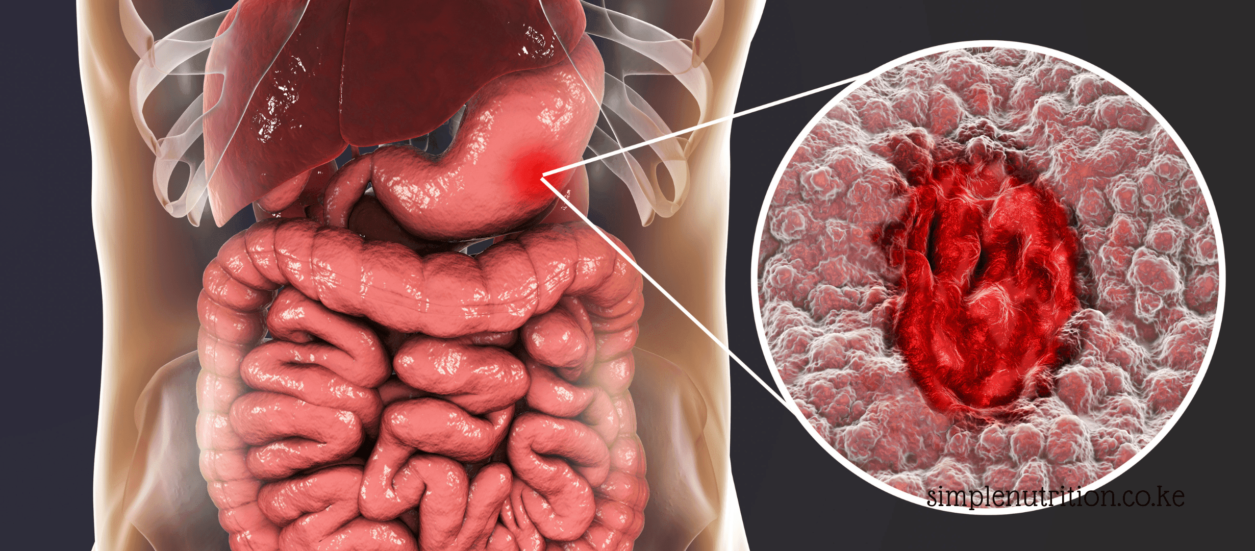 Stomach Ulcer: Hidden Food Triggers, Safe Alternatives.