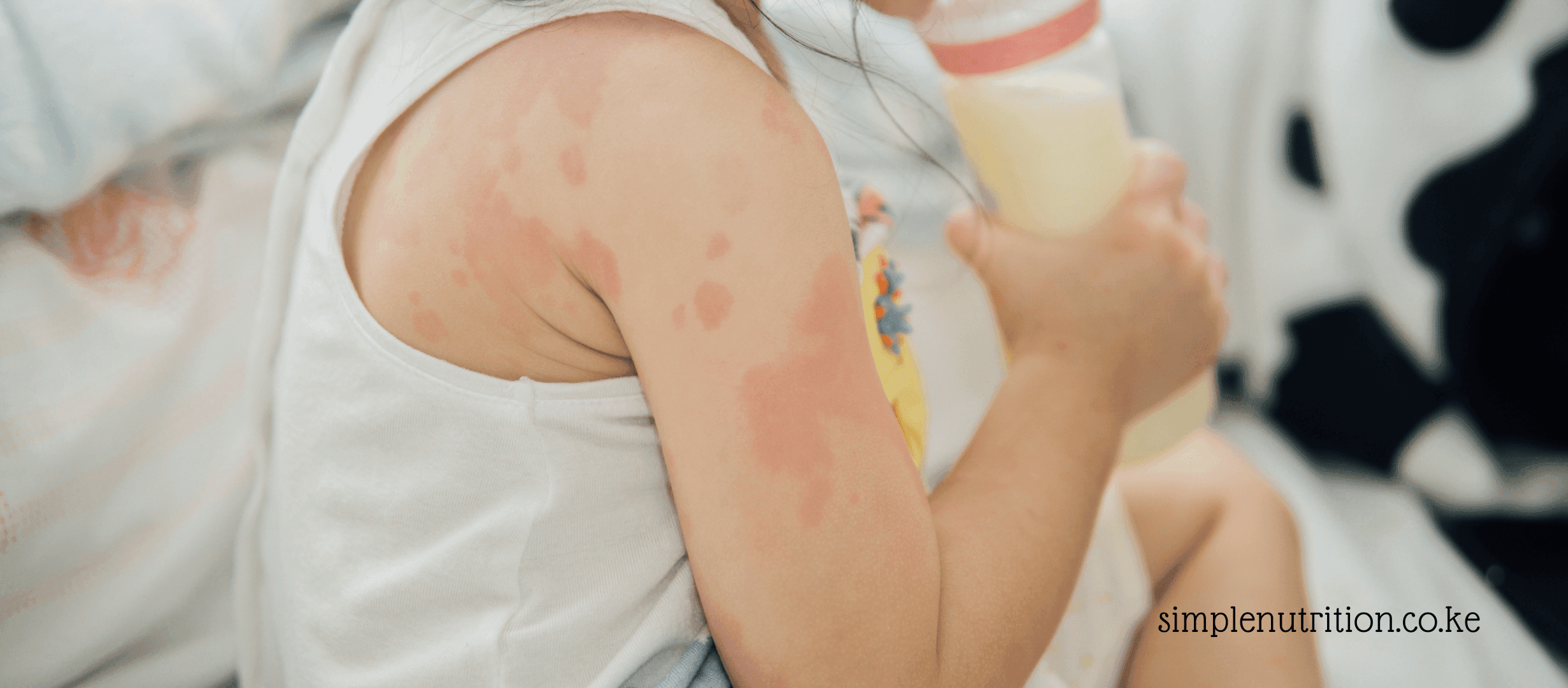 What to Feed Your Child Who Has Eczema
